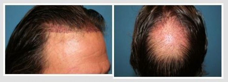 Visit Robotic Hair Transplants Cincinnati